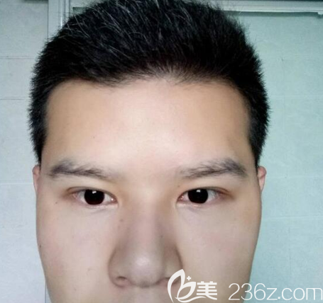 <i data-id='6f25ea73-45be-43f6-8020-50cbfcde0b3a' style='display:none;'></i>埋線雙眼皮術(shù)后一個月 <i data-id='6f25ea73-45be-43f6-8020-50cbfcde0b3a' style='display:none;'></i>埋線雙眼皮術(shù)后一個月