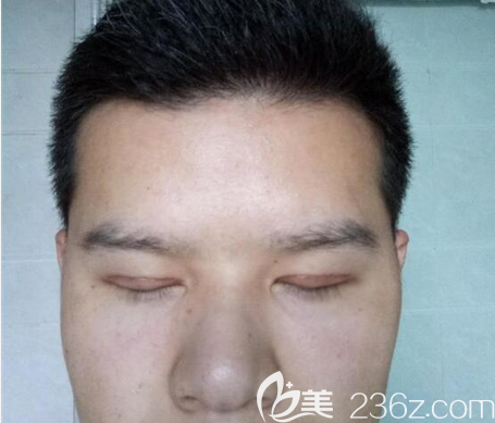 埋線雙眼皮術(shù)后一個月閉眼效果 埋線雙眼皮術(shù)后一個月閉眼效果