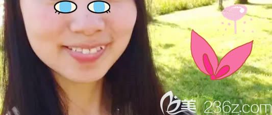 在天津美奧口腔醫(yī)院戴牙套前 在天津美奧口腔醫(yī)院戴牙套前