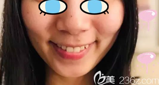 我原本想戴時代天使和隱適美牙套的,對比后去天津美奧做正雅牙齒矯正的效果也很贊哦