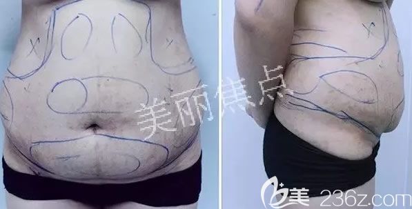 我在南寧美麗焦點(diǎn)整形做腰腹部吸脂術(shù)前設(shè)計(jì) 我在南寧美麗焦點(diǎn)整形做腰腹部吸脂術(shù)前設(shè)計(jì)