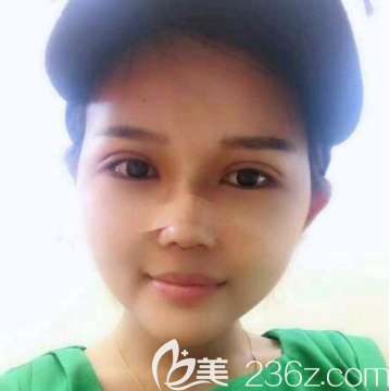 廣州美恩許揚濱雙眼皮隆鼻7天效果圖 廣州美恩許揚濱雙眼皮隆鼻7天效果圖