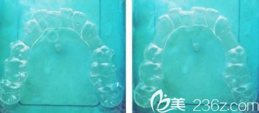 已經(jīng)佩戴過的正雅牙套 已經(jīng)佩戴過的正雅牙套