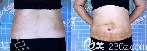 說下我在南寧美麗焦點整形做水動力腰腹部環(huán)形吸脂親身經(jīng)歷，恢復(fù)10天看到效果