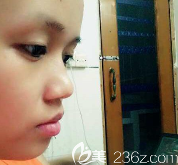 在廣州美恩做雙眼皮隆鼻術(shù)前照片 在廣州美恩做雙眼皮隆鼻術(shù)前照片