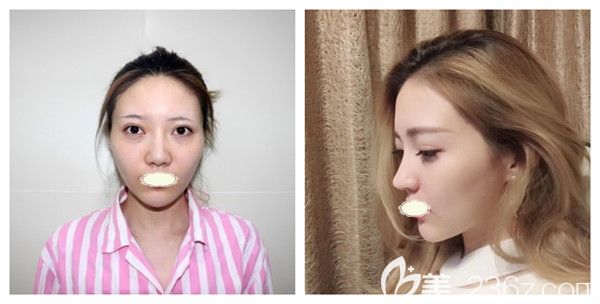 哈爾濱臻美王丹丹硅膠假體隆鼻案例對比圖