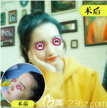 北京壹加壹郝文義醫(yī)生發(fā)際線種植案例