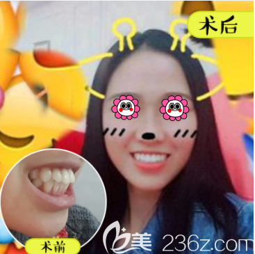 北京壹加壹張瑩醫(yī)生隱形托槽矯正案例