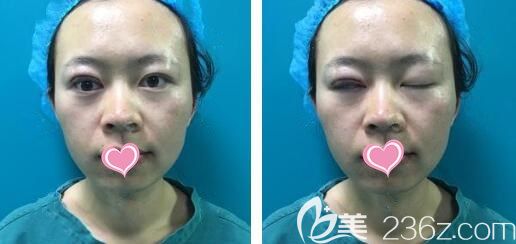 切開雙眼皮手術(shù)第2天感覺(jué)眼睛酸酸的 切開雙眼皮手術(shù)第2天感覺(jué)眼睛酸酸的