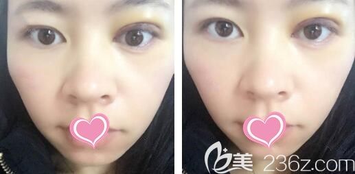 雙眼皮失敗修復(fù)第7天眼部線條流暢 雙眼皮失敗修復(fù)第7天眼部線條流暢