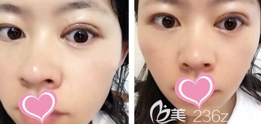 雙眼皮失敗二次修復(fù)第20天眼部腫脹和淤青已經(jīng)完全消退 雙眼皮失敗二次修復(fù)第20天眼部腫脹和淤青已經(jīng)完全消退