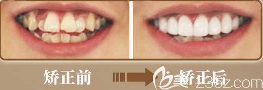 成都圣貝成人牙齒擁擠矯正前后對比效果