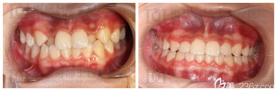 重慶牙齒矯正哪家強(qiáng)？牙博士劉永桂正畸案例實力驗證