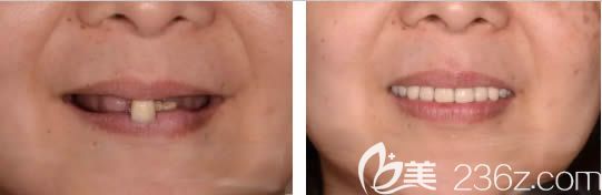 圣貝牙科6旬老人全口牙種植<span style=