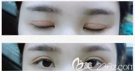 西寧時(shí)光全切雙眼皮第3天