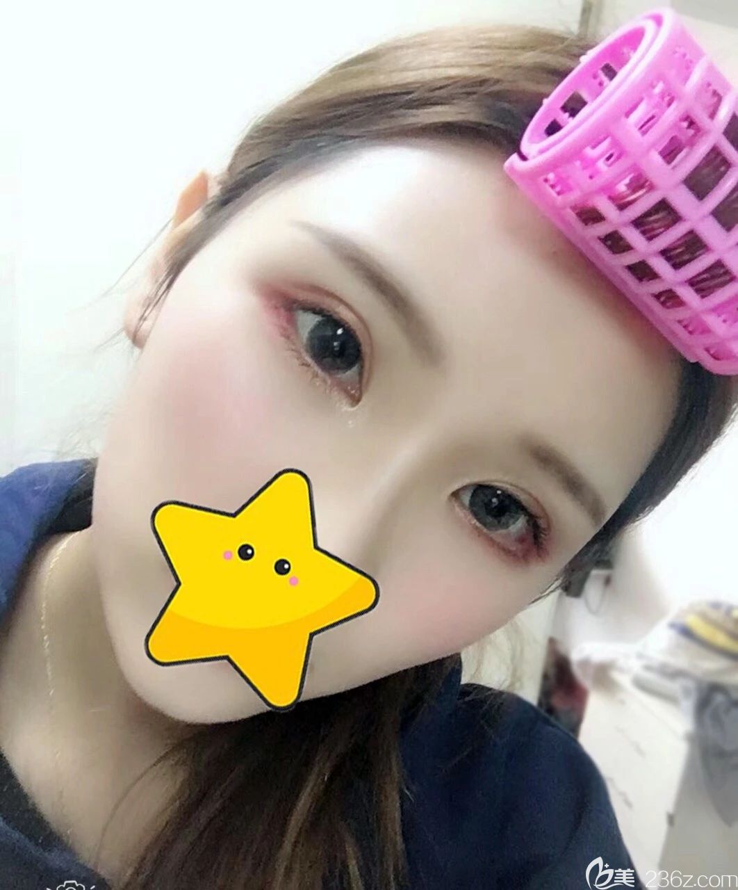 西寧時(shí)光<!--<i data=20240703-sp></i>-->全切雙眼皮一個(gè)月恢復(fù)<span style=