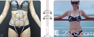 水動(dòng)力吸脂腰腹案例一