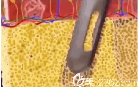 大腿環(huán)吸原理 大腿環(huán)吸原理