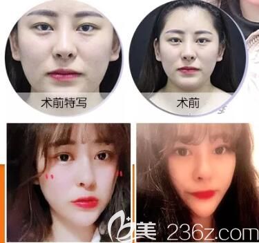 牛先翠主任自體脂肪面部填充術(shù)后效果對(duì)比