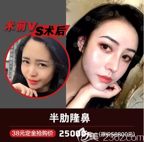 重慶華美隆鼻好不好