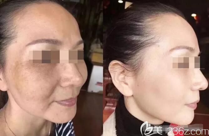 到常熟時代做激光祛斑前后對比案例 到常熟時代做激光祛斑前后對比案例