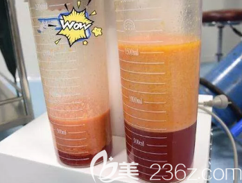 抽吸出來(lái)的脂肪樣子