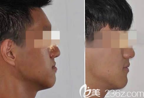 我在廣州圣貝口腔做牙齒矯正的前后對(duì)比圖 我在廣州圣貝口腔做牙齒矯正的前后對(duì)比圖