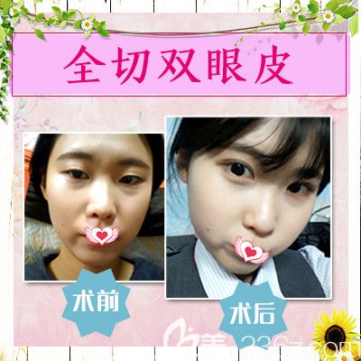 滄州做雙眼皮和隆鼻多少錢?華美3月女神季整形優(yōu)惠活動(dòng)價(jià)只需1584元