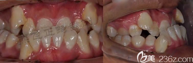 我做牙齒正畸之前的牙齒照片 我做牙齒正畸之前的牙齒照片