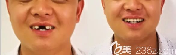 成都圣貝陳可前門牙缺失種植案例效果對比圖 成都圣貝陳可前門牙缺失種植案例效果對比圖