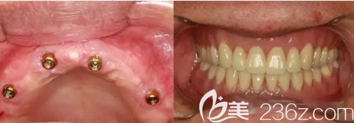 成都圣貝牙科陳可主任70歲老人全口牙種植前后對比效果 成都圣貝牙科陳可主任70歲老人全口牙種植前后對比效果