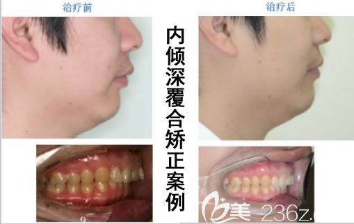 賈永慶主任青少年內(nèi)傾深覆合矯正前后對(duì)比效果及臉型變化圖 賈永慶主任青少年內(nèi)傾深覆合矯正前后對(duì)比效果及臉型變化圖