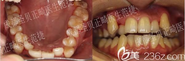 顧客戴牙套前的照片