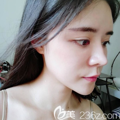 我去廣州天姿整形醫(yī)院找周祺院長做了全臉自體脂肪填充,因為面部凹陷讓我看起來很顯老