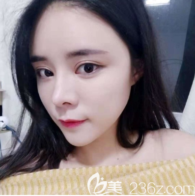 在廣州天姿做完脂肪填充全臉術(shù)后6天效果圖 在廣州天姿做完脂肪填充全臉術(shù)后6天效果圖