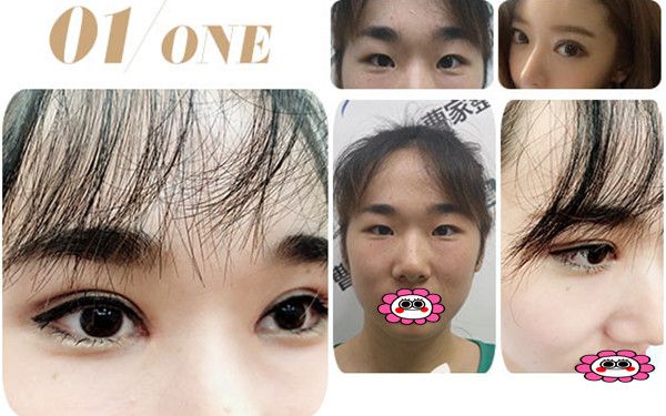 邵陽曹家整形割雙眼皮對(duì)比圖