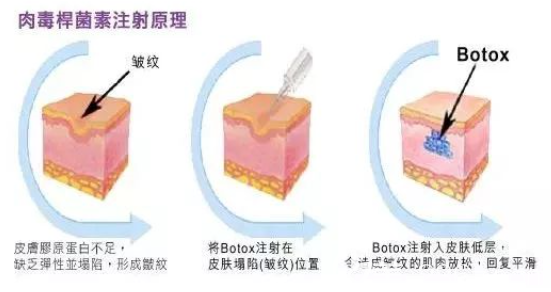 瘦臉除皺注射原理