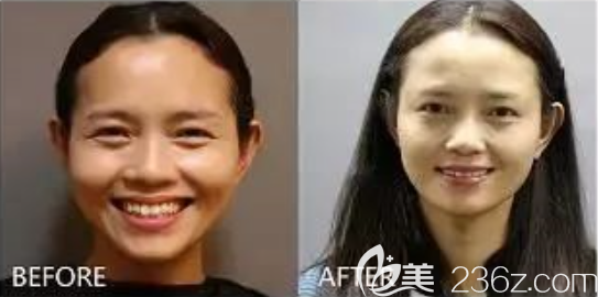 貴陽美萊整形祛魚尾紋案例