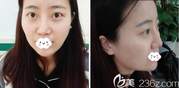 自體脂肪填充術(shù)前照片 自體脂肪填充術(shù)前照片