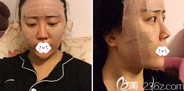 全面部脂肪填充+埋線提升術(shù)后即刻 全面部脂肪填充+埋線提升術(shù)后即刻