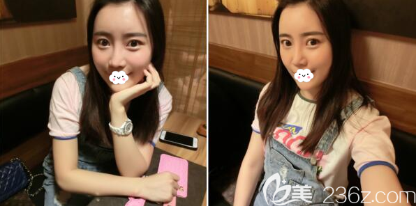 自體脂肪面部填充術(shù)后半個月恢復效果 自體脂肪面部填充術(shù)后半個月恢復效果