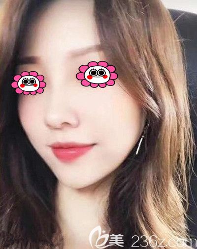 陪朋友到湘潭雅美整形做雙眼皮后我決定做玻尿酸豐下巴，大伙幫我看看效果怎樣？