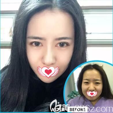 沈陽元辰元生態(tài)雙眼皮真人前后效果對比