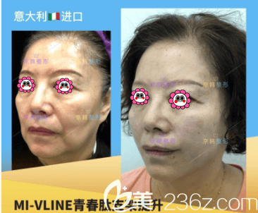 北京京韓張振醫(yī)生青春肽線雕提升案例