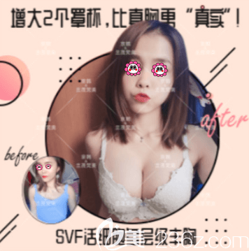 北京京韓王沛森醫(yī)生SVF活性自體脂肪隆胸案例