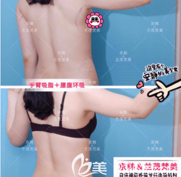 北京京韓王沛森醫(yī)生手臂+腰腹環(huán)吸案例