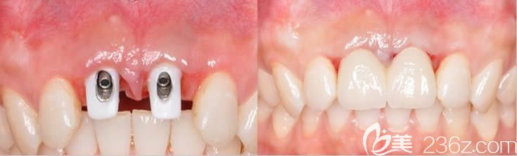 廣州圣貝口腔孫世堯門牙種植效果對比圖 廣州圣貝口腔孫世堯門牙種植效果對比圖