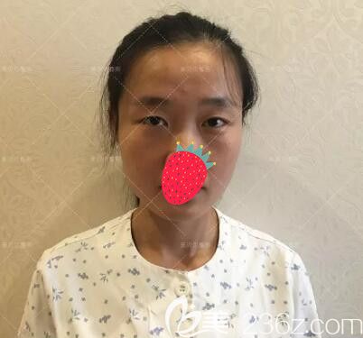 面診蘇州美貝爾術(shù)前無(wú)神單眼皮 面診蘇州美貝爾術(shù)前無(wú)神單眼皮