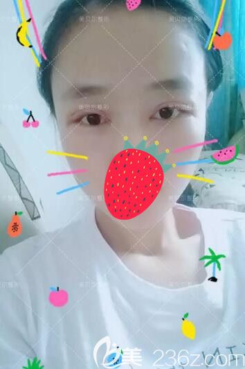 找譚亮醫(yī)生做眼綜合術(shù)后一周拆線 找譚亮醫(yī)生做眼綜合術(shù)后一周拆線