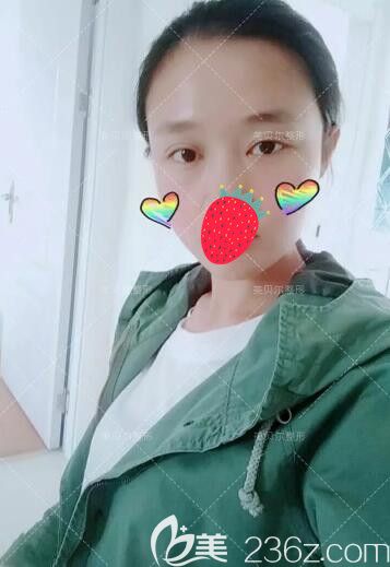 譚亮分享做完雙眼皮+去皮去脂術(shù)后半個(gè)月恢復(fù) 譚亮分享做完雙眼皮+去皮去脂術(shù)后半個(gè)月恢復(fù)